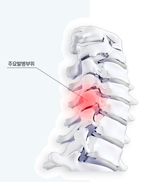 경추 척추관 협착증 3d모형 이미지